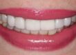 el paso teeth whitening