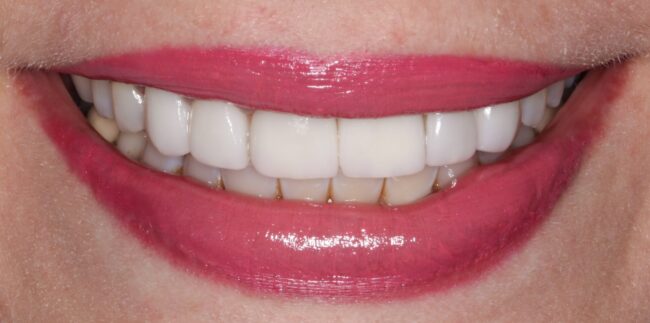 After el paso teeth whitening