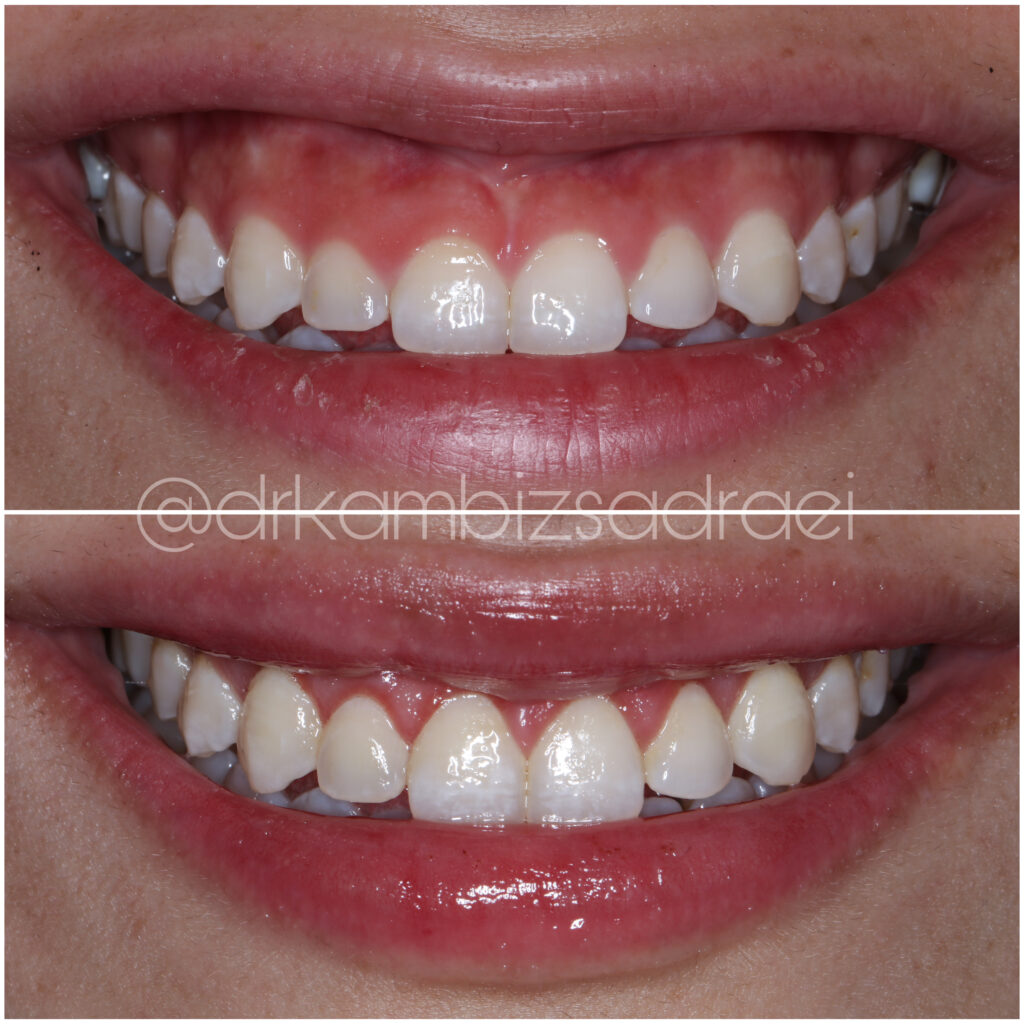 Gummy Smile Surgery Divine Dental Spa, El Paso