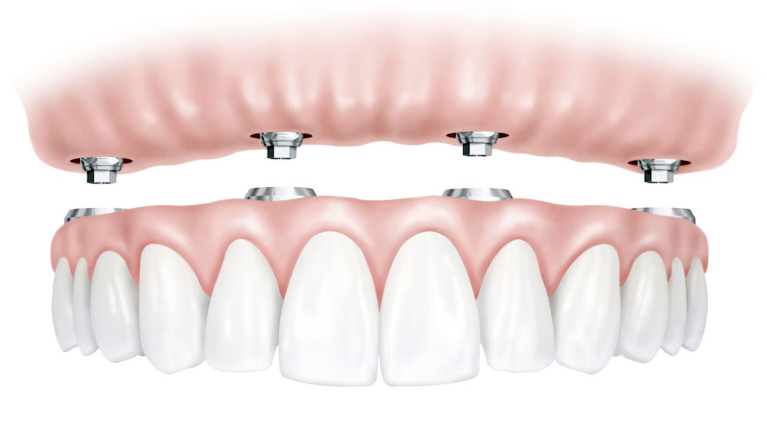 All on 4 Dental Implants Divine Dental Spa El Paso, TX