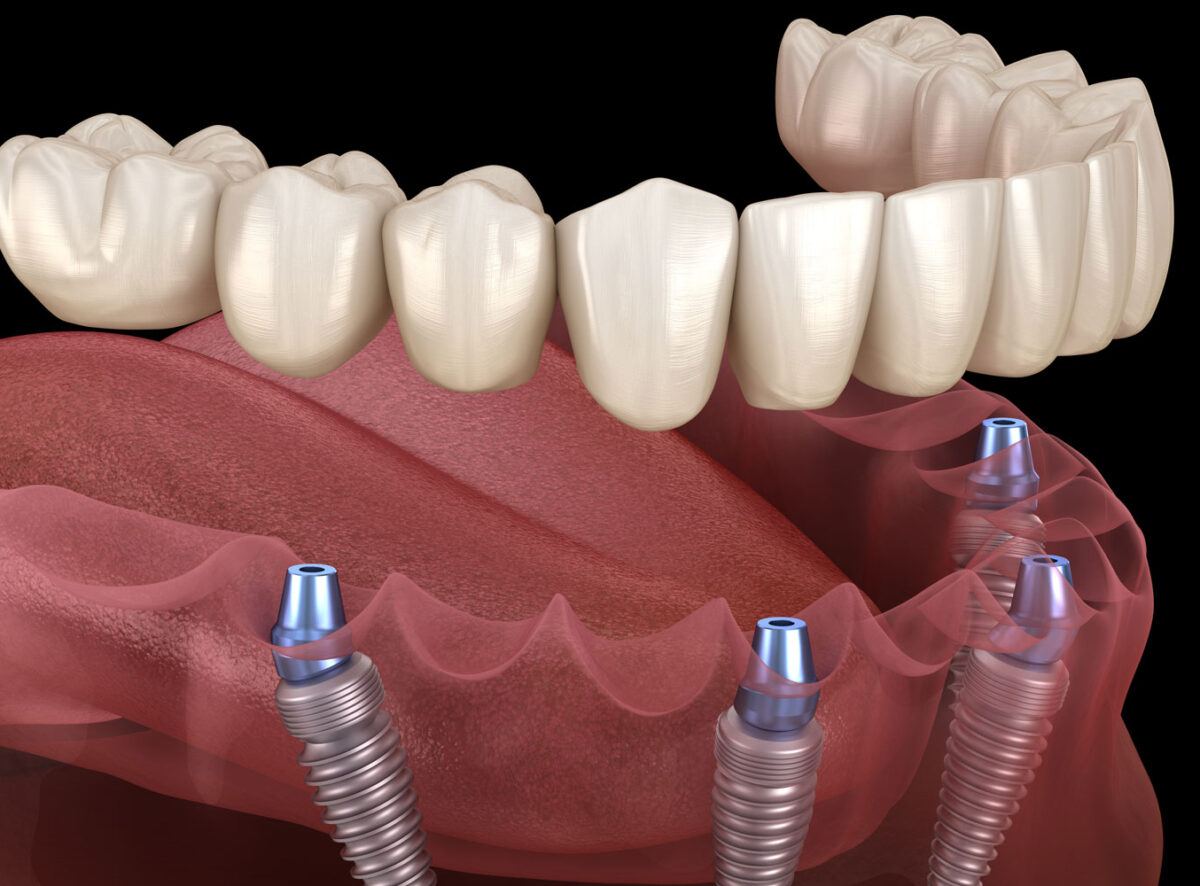 full-arch-dental-implants-model-2-6