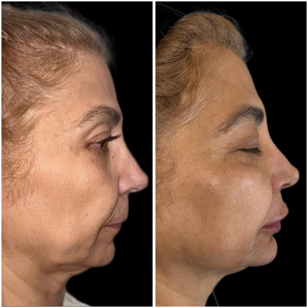 Dermal Fillers Divine Dental Spa El Paso, TX