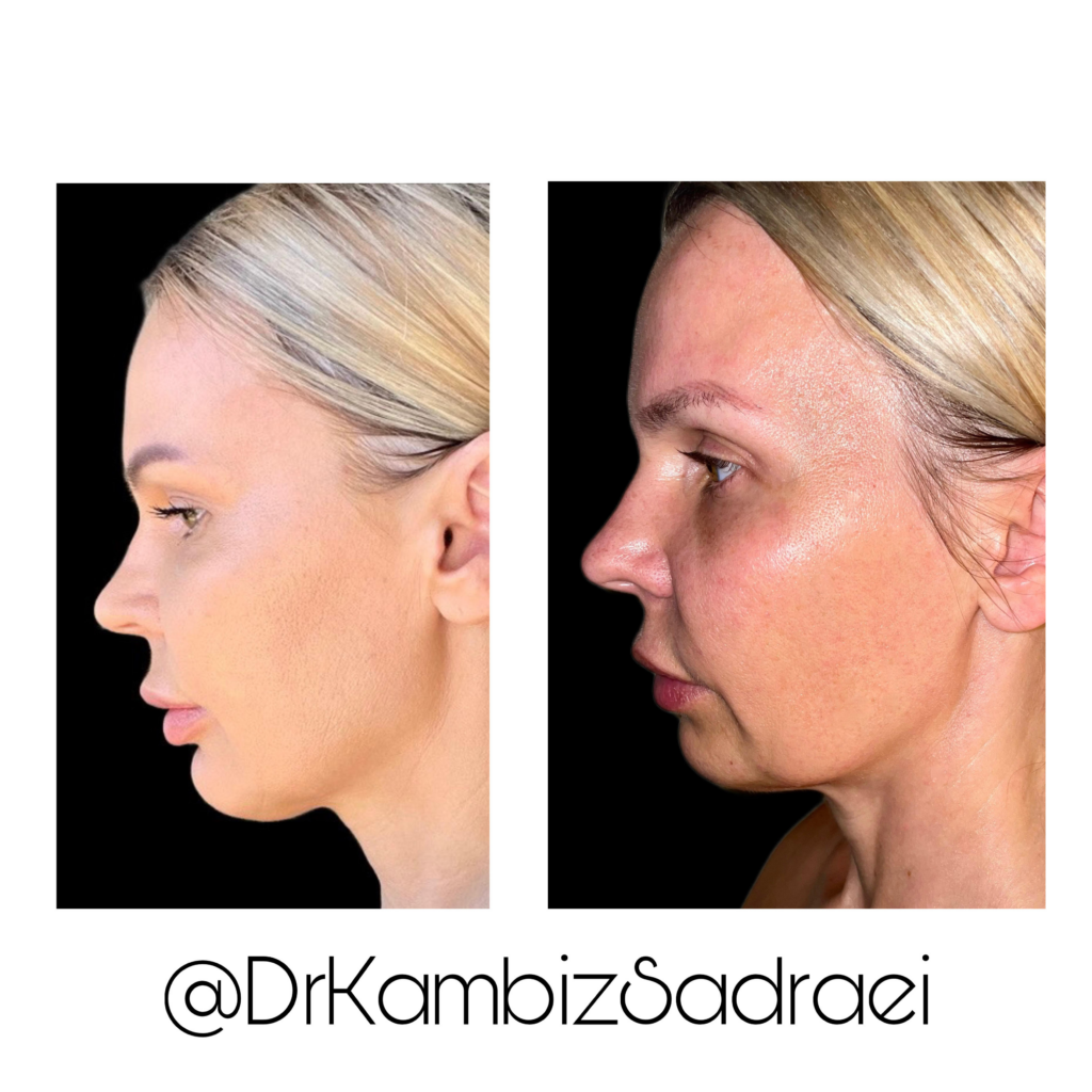 Dermal Fillers Divine Dental Spa El Paso, TX