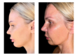 Dermal fillers at Divine Dental Spa: Achieve a youthful, refreshed appearance