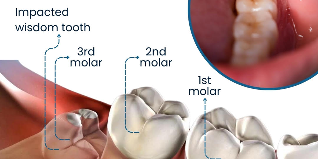 image (2) Wisdom teeth extractions at Divine Dental Spa: Prevent complications and ensure oral health