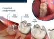 Wisdom teeth extractions at Divine Dental Spa: Prevent complications and ensure oral health