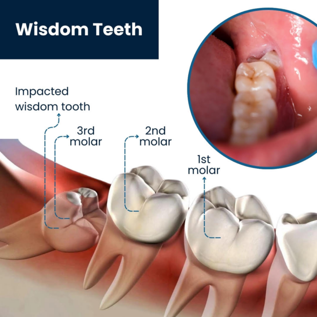 image (2) Wisdom teeth extractions at Divine Dental Spa: Prevent complications and ensure oral health