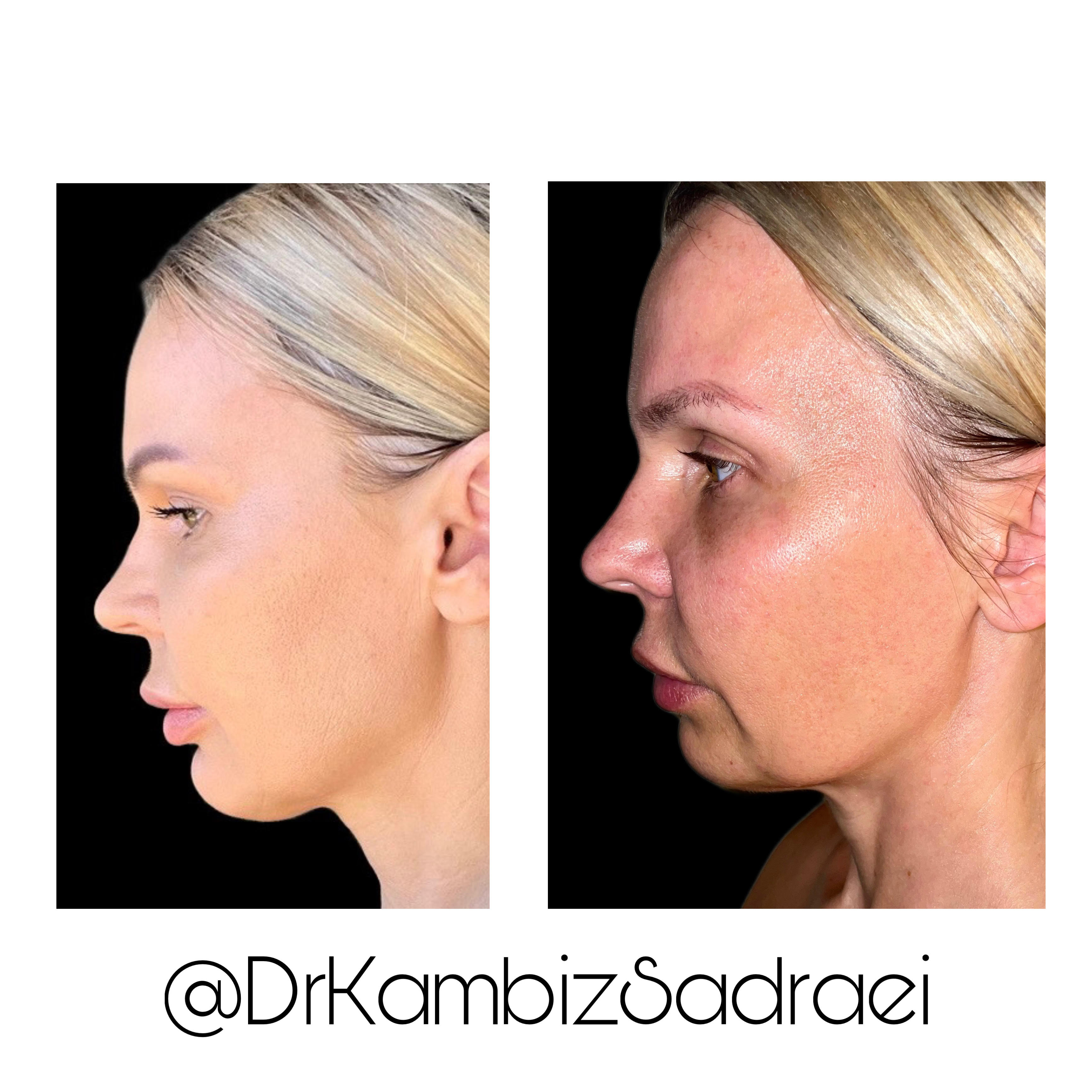 Dermal fillers at Divine Dental Spa: Achieve a youthful, refreshed appearance